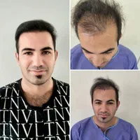 کاشت مو تراکم بالا (بدون تراشیدن سر)|خدمات آرایشگری و زیبایی|محمدشهر, |دیوار