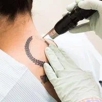 لیزر کیوسوئیچ، از بردن بردن تتو، لک و خال های رنگی