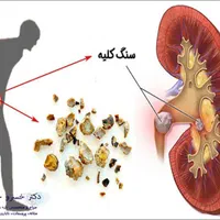 درمان سنگ کلیه بدون قرص شیمیایی