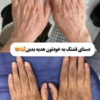 روشن شدن زیر بغل و زانو و آرنج با لیزر کیوسویچ|خدمات آرایشگری و زیبایی|کرج, گوهردشت|دیوار