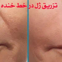 ژل لب مدل روسی و طبیعی بوتاکس میگرن مزوژل|خدمات آرایشگری و زیبایی|تهران, شاهین|دیوار