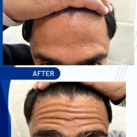 بوتاکس/مصپورت/دیستون/نابوتا/رفع چین و چروک و تعریق|خدمات آرایشگری و زیبایی|شیراز, فضل‌آباد|دیوار