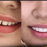 تخفیف ویژه کامپوزیت و لمینت با بهترین متخصصان|خدمات آرایشگری و زیبایی|شیراز, فرهنگ شهر|دیوار