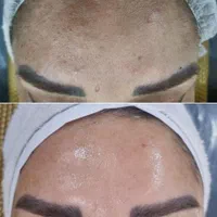 مدل پاکسازی رفع غبغب روشن کننده بیکینی و جراحی|خدمات آرایشگری و زیبایی|تهران, شهرک ولیعصر جنوبی|دیوار