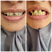 دندانسازی(بلوارهدایت)دندان مصنوعی/دندان سازی|خدمات آرایشگری و زیبایی|مشهد, هدایت|دیوار