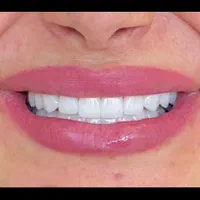 دست دندان مصنوعی طرح لمینیت|خدمات آرایشگری و زیبایی|تهران, تهرانپارس غربی|دیوار