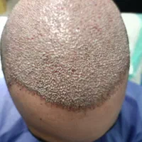 کاشت مو ، ریش و ابرو|استخدام درمانی، زیبایی، بهداشتی|شیراز, بعثت|دیوار
