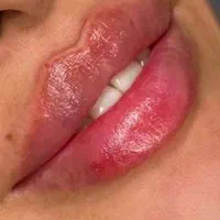تزریق ژل لب روسی آنزیم زاویه سازی لیزر توسط پزشک|خدمات آرایشگری و زیبایی|تهران, صادقیه|دیوار
