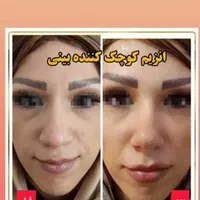 آنزیم ژل لب.بینی.غعبغب. ژل های گلوله شده چربی سوز|خدمات آرایشگری و زیبایی|خرم‌آباد, |دیوار