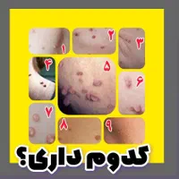 درمان زگیل و تبخال تناسلی ...باروشی نوین و ریشه ای