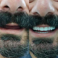 دندانسازی محمدی/طرح کامپوزیت