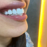 کامپوزیت دندان|خدمات آرایشگری و زیبایی|اسلام‌شهر, شهرک مهدیه|دیوار