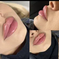 لیزرتیتانیوم،ژل لب فول فیس فیشیال مزو هایفو بوتاکس|خدمات آرایشگری و زیبایی|مشهد, آزادشهر|دیوار