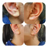 الکترولیز.پیرسینگ.پلاسما.خالبرداری