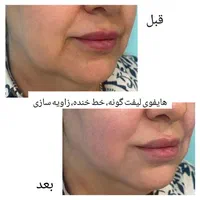 کیوسوئیچ، ریموو تتو،هایفو، جوانسازی،لیزر|خدمات آرایشگری و زیبایی|آبادان, |دیوار