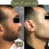 جشنواره بوتاکس،فیلر،‌لب روسی،جوانسازی،توسط پزشک|خدمات آرایشگری و زیبایی|زنجان, |دیوار