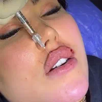 دکتر متخصص تزریق ژل لب روسی فیلر بینی زاویه پزشک|خدمات آرایشگری و زیبایی|تهران, پونک|دیوار