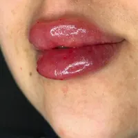 مطب تخفیف ژل و فیلر لب و صورت و بوتاکس|خدمات آرایشگری و زیبایی|قم, صفائیه|دیوار