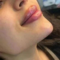 بوتاکس،تزریق ژل،مزوزیرچشم وصورت ،پرسینگ محمدشهر|خدمات آرایشگری و زیبایی|محمدشهر, |دیوار