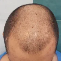 کاشت مو|خدمات آرایشگری و زیبایی|اصفهان, باغ زیار|دیوار