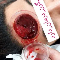 حجامت رفع مشکلات کبدی تیرگی پوست خستگی و غلظت خون|خدمات آرایشگری و زیبایی|ایلام, |دیوار