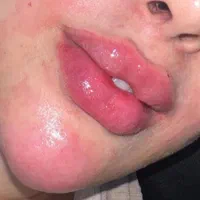 ژل لب و صورت بوتاکس|خدمات آرایشگری و زیبایی|رشت, گلسار|دیوار