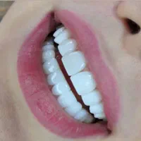 کامپوزیت زیبایی دندانپزشکی|خدمات آرایشگری و زیبایی|یاسوج, |دیوار