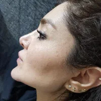 ژل بوتاکس خالبرداری فشیال زگیل تناسلی مطب زیبایی|خدمات آرایشگری و زیبایی|تبریز, |دیوار