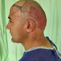 کاشت مو ابرو درمرکزجراحی بیمارستانی نه کلینیک ومطب
