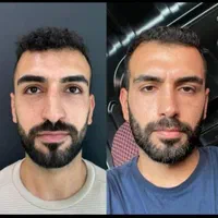 جراحی بینی  لیپوماتیک  پروتز سینه ابدو مامو لیفت|خدمات آرایشگری و زیبایی|اصفهان, مرداویج|دیوار
