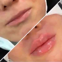 تزریق ژل مدل زاویه،گونه،چونه،لب|خدمات آرایشگری و زیبایی|تهران, امام زاده حسن|دیوار
