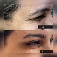 بوتاکس صورت و زیر بغل(جشنواره)در مطب|خدمات آرایشگری و زیبایی|اصفهان, ملک‌شهر|دیوار