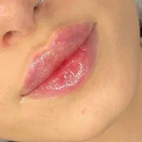 تزریق ژل وبوتاکس،نخ کاگ یالیفت صورت،اموزش|خدمات آرایشگری و زیبایی|تهران, شهرک شریعتی|دیوار