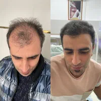 جشنواره کاشت مو|خدمات آرایشگری و زیبایی|زنجان, |دیوار