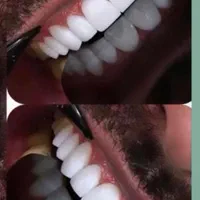 کامپوزیت دندان جشنواره تابستانه فقط تا ده روز|خدمات آرایشگری و زیبایی|کرج, گوهردشت|دیوار