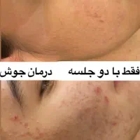 لیزر کیوسوئیچ رفع تیرگی صورت بیکینی و ریمو تاتو|خدمات آرایشگری و زیبایی|ارومیه, |دیوار