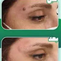 برداشت خال بدون درد و خونریزی