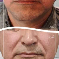 ژل خط خنده ( شوش)|خدمات آرایشگری و زیبایی|شوش, |دیوار