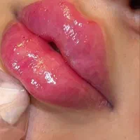 ژل وبوتاکس