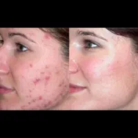 تخصصی پی آر پیprpحرفه ای بوتاکس ژل حجامت70فیلر فصد|خدمات آرایشگری و زیبایی|اصفهان, وحید|دیوار