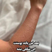 مطب لیزر موهای زائد الکس گرویتی کندلا ملاصدرا|خدمات آرایشگری و زیبایی|تهران, ونک|دیوار