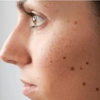 برداشت خال،اسکین تگ،زگیل،کک ومک واسترج مارک|خدمات آرایشگری و زیبایی|شاهین‌شهر, فیض|دیوار