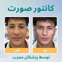 زاویه سازی صورت/فیلر و نانو فت/ در یک جلسه|خدمات آرایشگری و زیبایی|تهران, دروس|دیوار