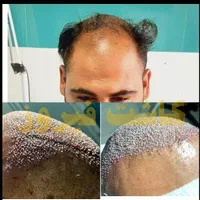 کاشت مو فول تراکم|خدمات آرایشگری و زیبایی|تهران, نارمک|دیوار