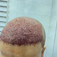 کاشت موی طبیعی به روش fit ،و سوپر sut|خدمات آرایشگری و زیبایی|اهواز, کیانپارس |دیوار