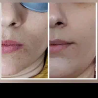 مرکز لیزر رز (پاک تتو و کربن تراپی)|خدمات آرایشگری و زیبایی|مشهد, هنرور|دیوار