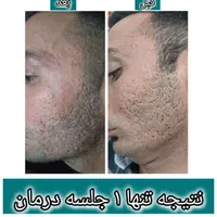 درمان تضمینی وماندگار تو رفتگی پوستی/جای جوش/اسکار|خدمات آرایشگری و زیبایی|اصفهان, باغ دریاچه|دیوار