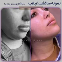 رفع و ساکشن غبغب 100% تضمین کتبی|خدمات آرایشگری و زیبایی|تهران, صادقیه|دیوار