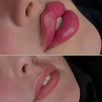 جشنواره تزریق ژل و بوتاکس وفیلر زیر چشم|خدمات آرایشگری و زیبایی|تهران, مرزداران|دیوار