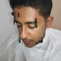 حجامت بختیاری ها،طب سنتی سوزنی ،فصد،زالو prp